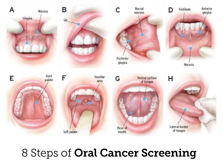 Oral Cancer Screening White Bear Lake Dentist Mn 55110 Periodontal